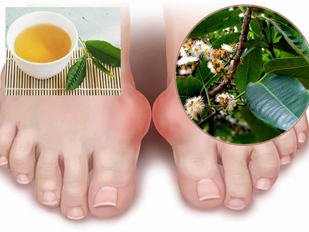 Hỗ trợ điều trị bệnh gout